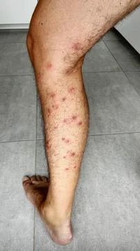 Bright red marks from insect bites on male human legs. Cercaria bite Stock Photos