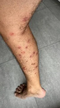 Bright red marks from insect bites on male human legs. Cercaria bite Stock Photos