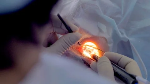 A brightly lit eye socket during surgery. Stock Footage 84198442