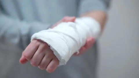 The broken arm of a man in gaps. Plaster cast on a broken arm close-up. Stock Footage 233925481