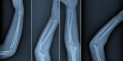 Broken arm xray Stock Photos