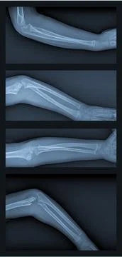Broken arm xray Foto stock
