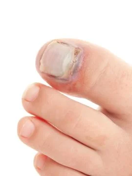 Broken big toe with nail detachment Stock Photos