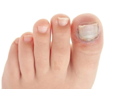 Broken big toe with nail detachment Foto stock