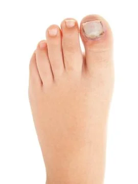 Broken big toe with nail detachment Stock Photos