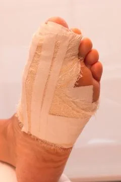 Broken Big Toe Stock Photos