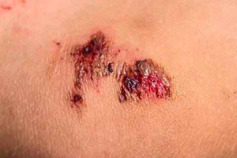 Broken bleeding knee with deep scratches on the skin with wet tracks. Wounds, Stock Photos
