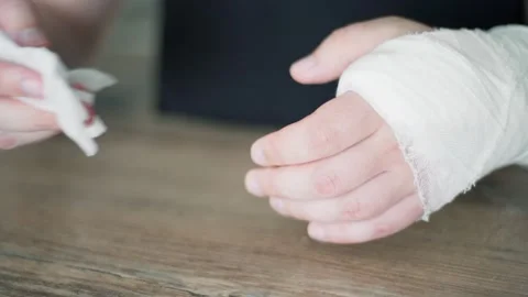 Broken bone. A man washes a broken arm in gypsum with a napkin. Difficult care Video stock 133077311