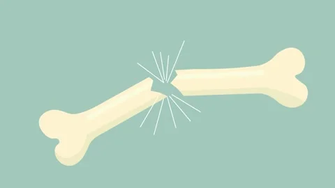 Broken Bone or Fracture in the middle with break effect flat design animati.. Stock Footage 304774807