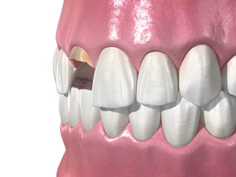 Broken central incisor tooth. Medically accurate 3D illustration Stock Illustration