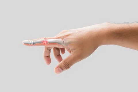 Broken forefinger Foto stock