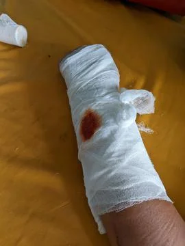 Broken hand bones Foto stock