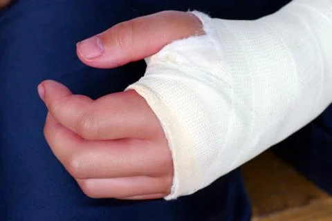 Broken hand with plaster cast close up Stock Photos