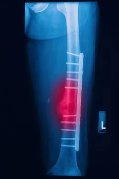 Broken human thigh x-rays image with implant ( plate and screw ) Stock Photos