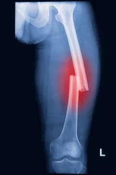 Broken human thigh x-rays image Stock Photos