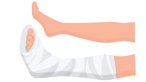 Broken leg Ankle Stock Illustration