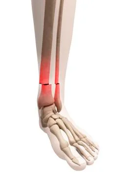 Broken leg bone, illustration Illustrazione stock