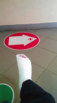 Broken leg 스톡 사진