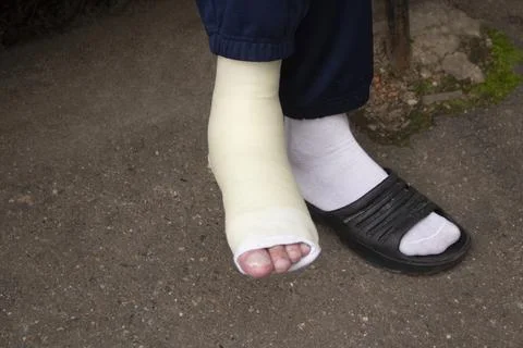 Broken leg in plaster. Damage to limb. Human legs. Plaster on foot. Stock Photos