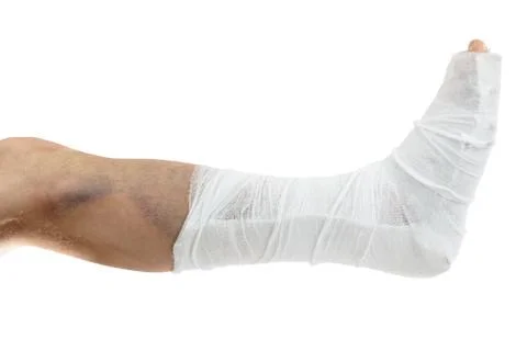 Broken leg in plaster. isolate. Stock Photos