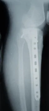 Broken leg, X-ray Stock Photos