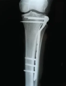 Broken leg, X-ray Stock Photos