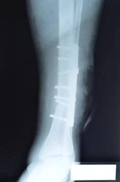 Broken leg, X-ray Stock Photos
