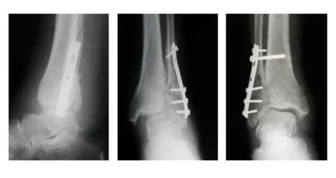 Broken leg, X-ray set Stock Photos