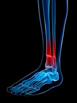 Broken lower leg bones, Illustration Stock Illustration
