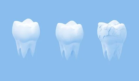 Broken molars tooth Stock Illustration