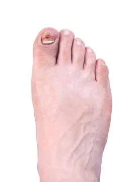 Broken nail Stock Photos