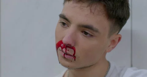 Broken nose of a guy in a white T-shirt. He is in the psyche of frustration Video stock 231498364