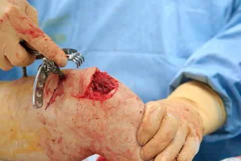 Broken Shin Bone Stockfoto's