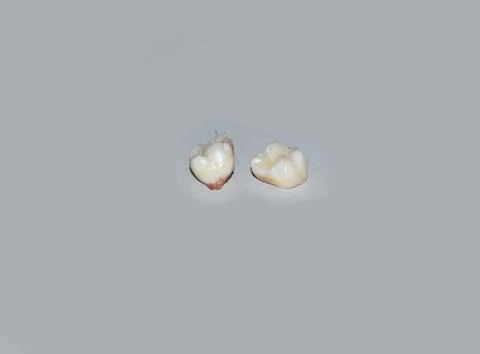 Broken Teeth or Tooth Foto stock