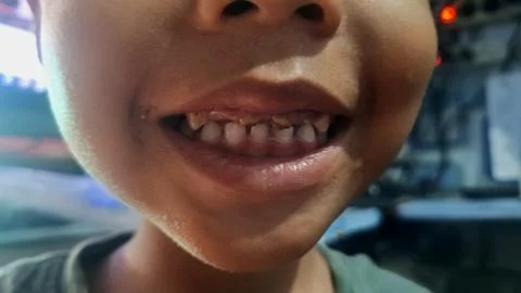 Broken teeth Stock Photos