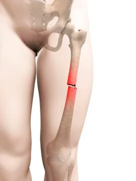 Broken thigh bone, illustration Stock Illustration