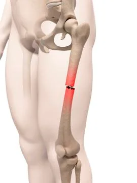 Broken thigh bone, illustration Stock Illustration