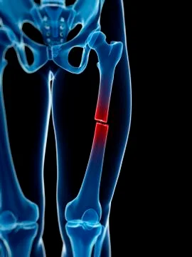 Broken thigh bone, illustration Stock Illustration