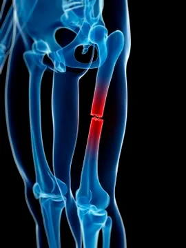 Broken thigh bone, illustration Stock Illustration