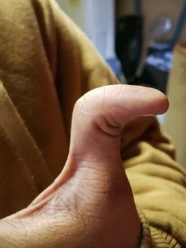 Broken thumb Stock Photos