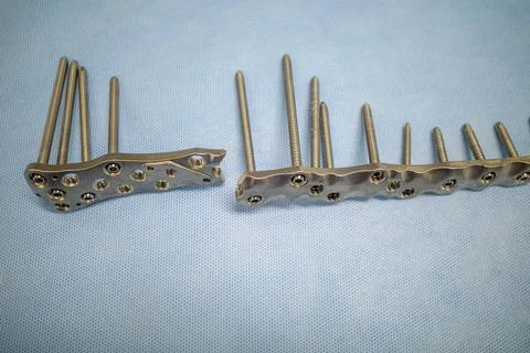 A broken titanium plate was explanted in one patient Stock Photos