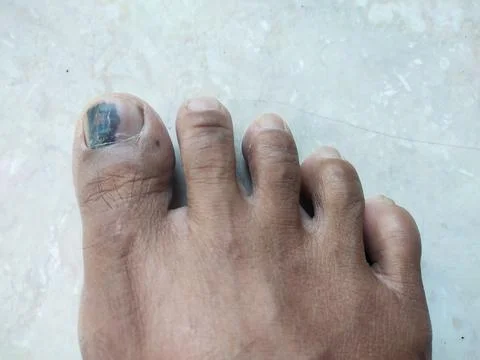 Broken toenails Stock Photos