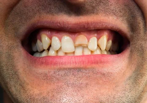 Broken tooth. Broken upper incisor in a man mouth. Stock Photos