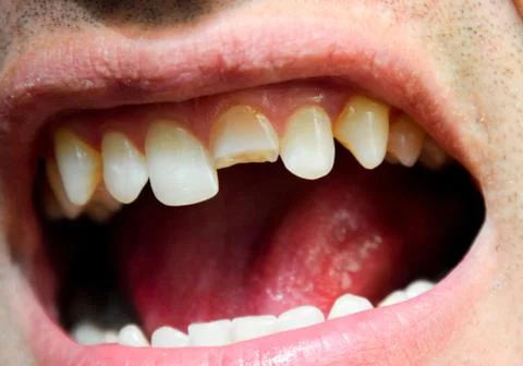 Broken tooth. Broken upper incisor in a man mouth. Stock Photos