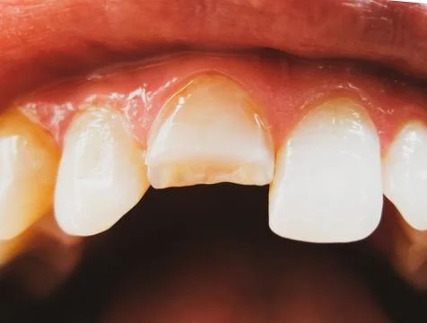 Broken tooth. Broken upper incisor in a man mouth. Stock Photos