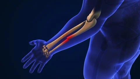 Broken Ulna Bone medical concept 動画素材 278863427