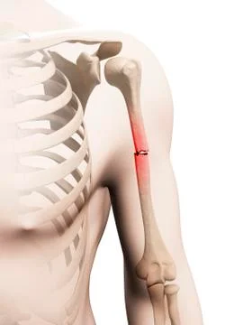 Broken upper arm bone, Illustration Stock Illustration