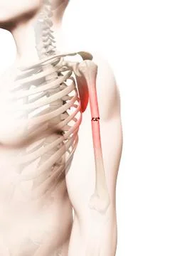 Broken upper arm bone, Illustration Stock Illustration