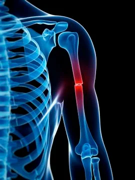 Broken upper arm bone, Illustration Stock Illustration