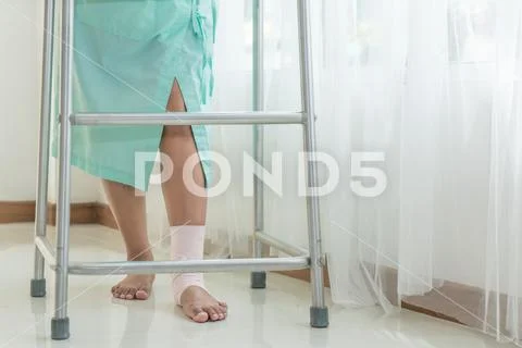 Broken woman leg, splint for treatment of injuries from broken bones in hospi Stock Photos
